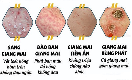dau-hieu-giang-mai.png