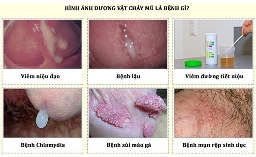 chảy mủ.jpg