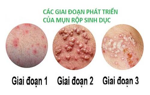 mun-rop-sinh-duc-de-bi-nham-lan-voi-mun-thuong-va-cac-benh-tinh-duc-khac.jpg